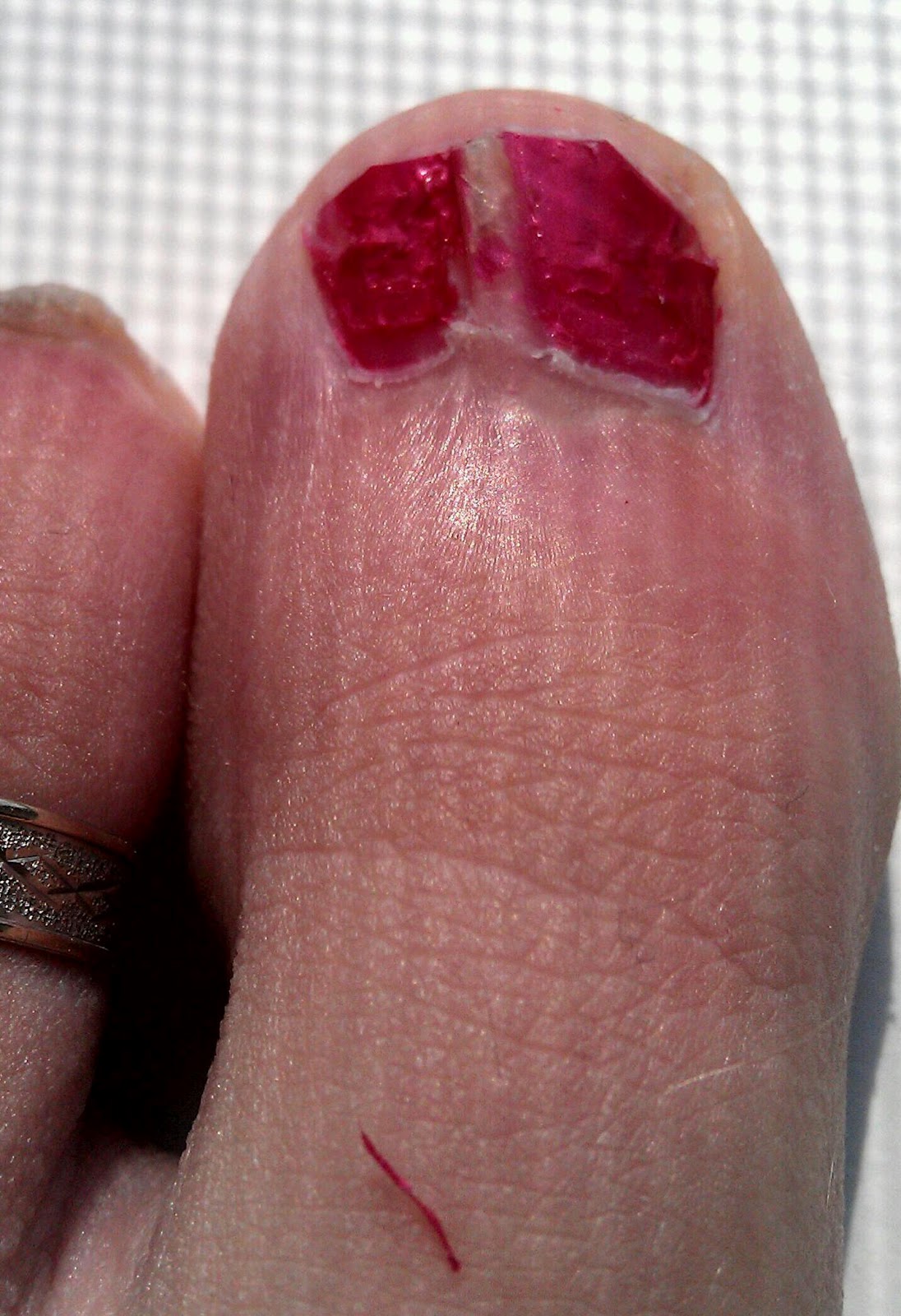 Nail Cracked Down Middle