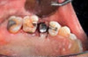 All On 4 Dental Implants Sun City