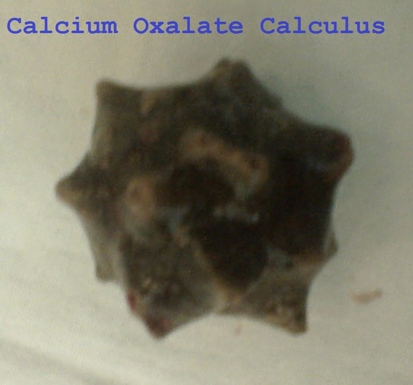 Calcium Oxalate Calculus Pic 2 Calcium Oxalate Calculus Pic 2
