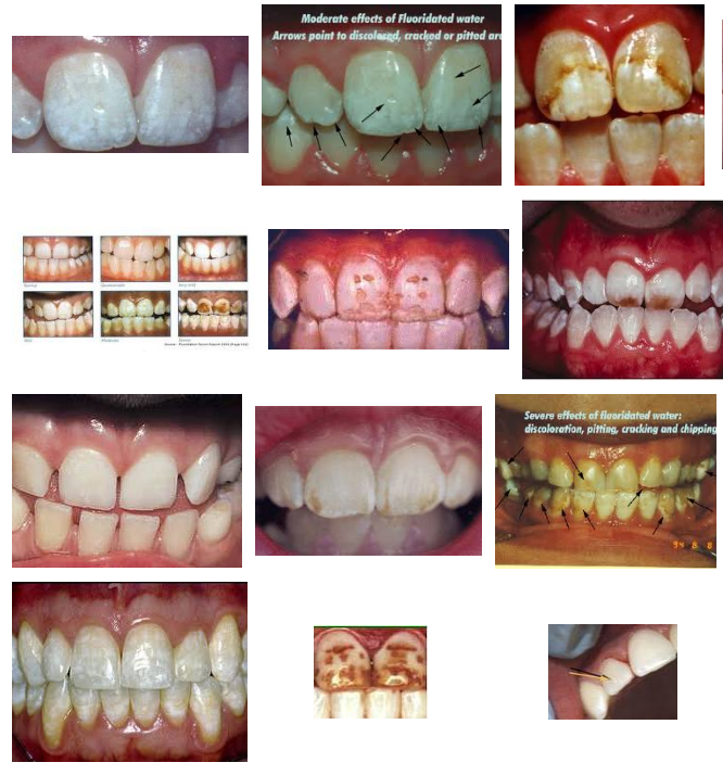 Simple Healthy Living Information Fluoride