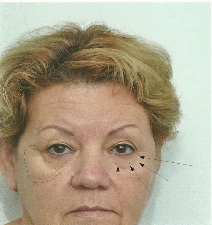 Carlos Spera Plastic Surgery LOWER EYELID “BAGS” AND MALAR “FESTOONS”