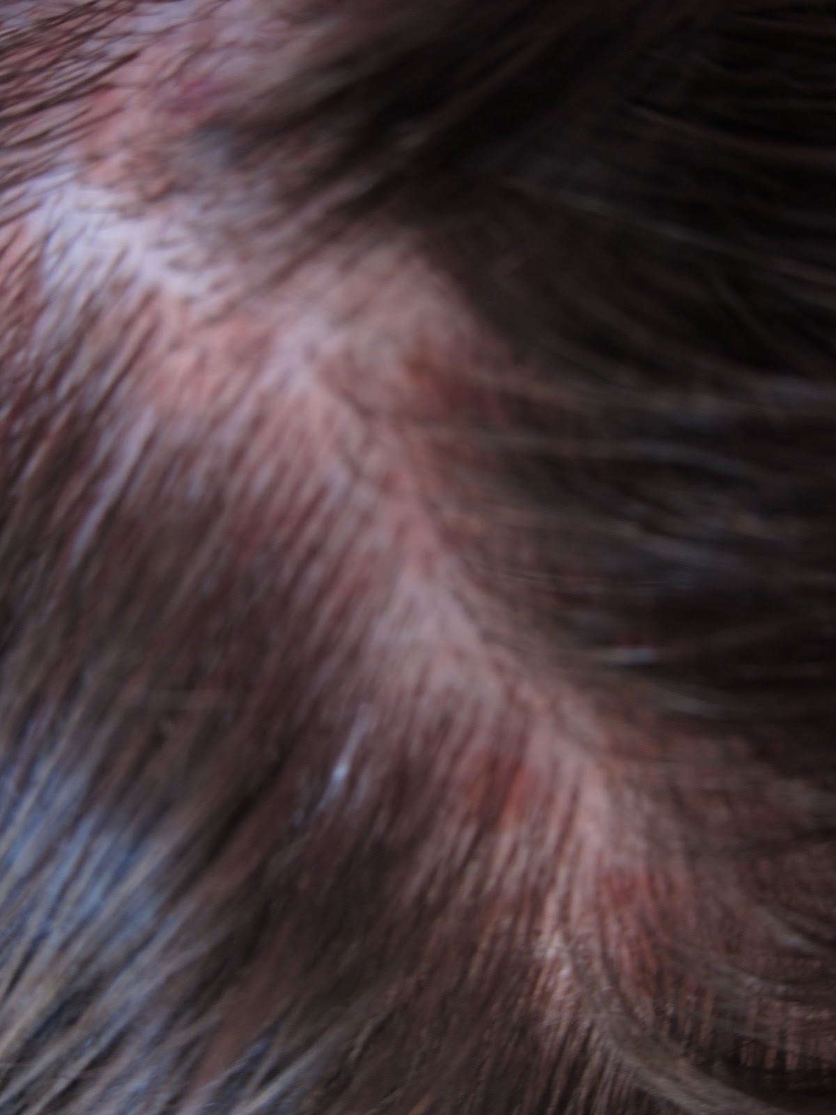 rash on head