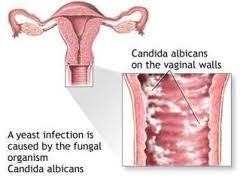 yeast infections a yeast infection