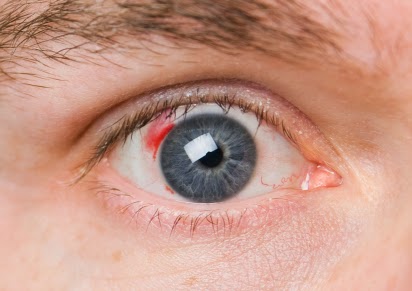 Operasi Lasik | Operasi Lasik Mata Operasi Lasik | Operasi Lasik Mata