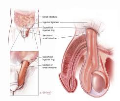 obat tradisional hernia obat tradisional hernia