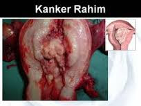 Obat Alami Kanker Rahim