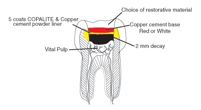 indirect pulp cap