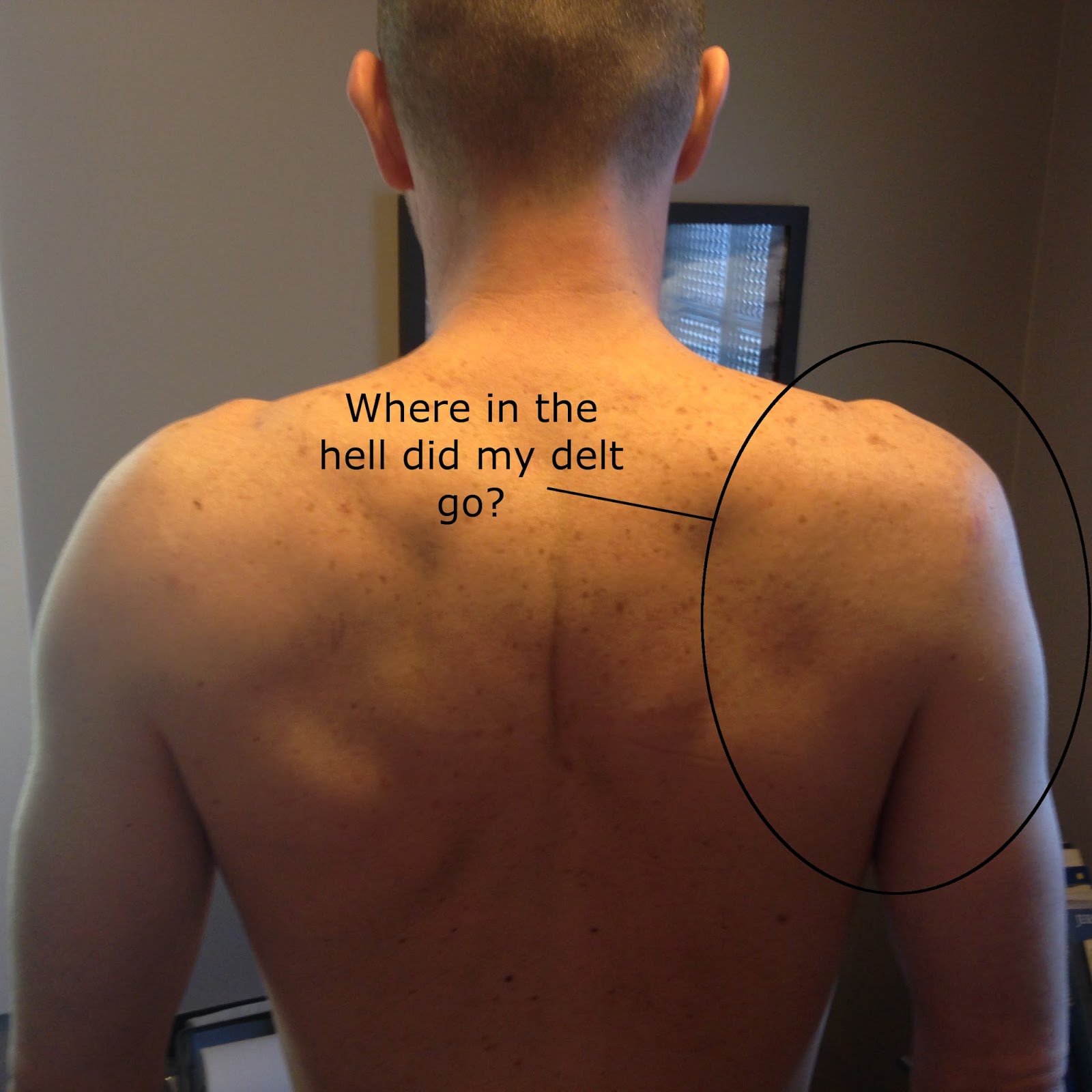 Collection 101+ Pictures Pictures Of Muscle Atrophy In Legs Excellent