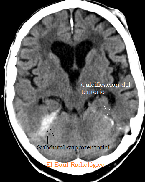 subdural+laminar+2.png