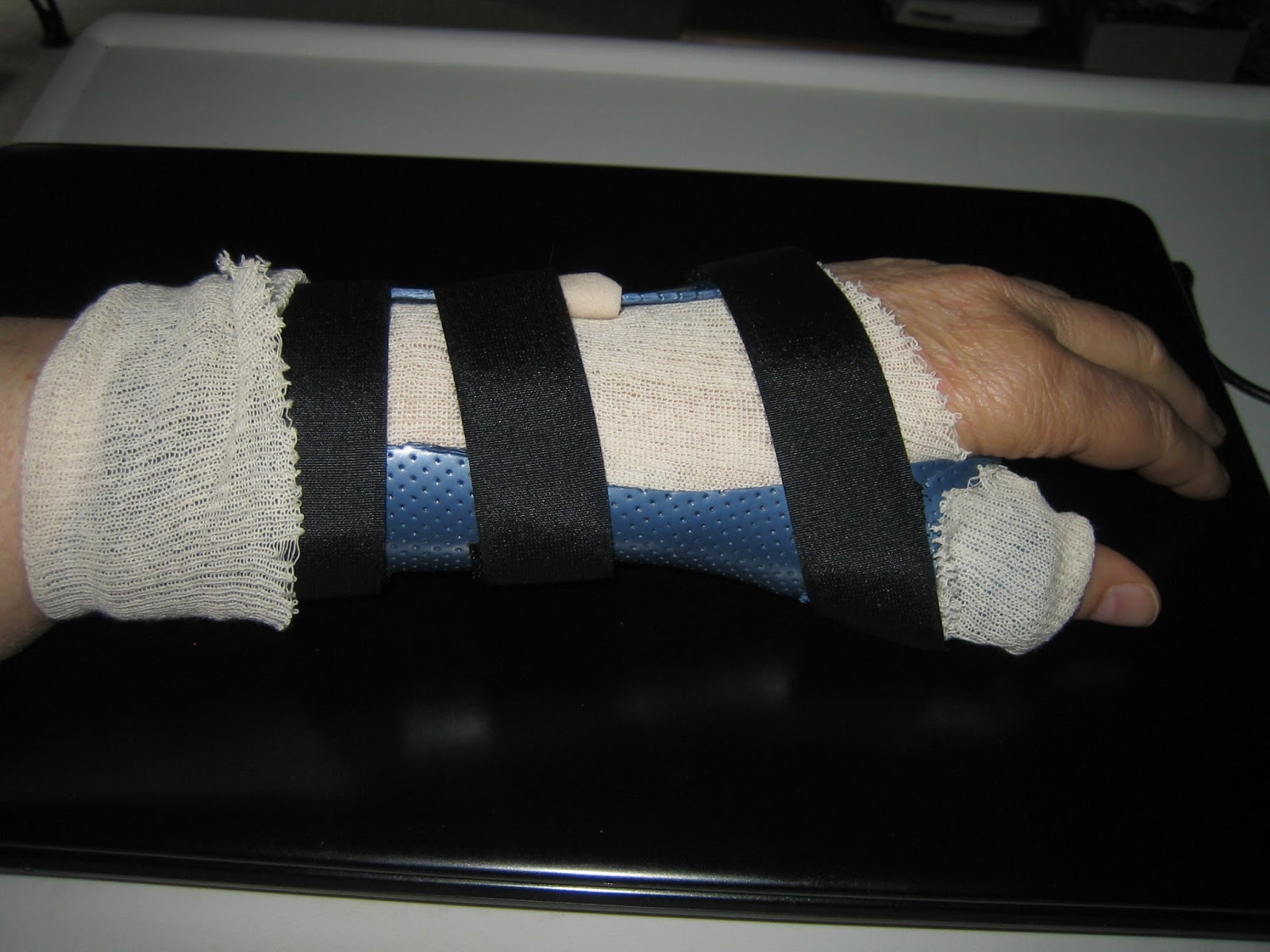 Quilting Momma & The Youngest 11 days post surgery Basal thumb