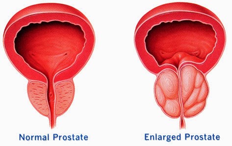 PROSTATE