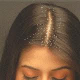 Cara Mengatasi Rambut Berketombe Cara Mengatasi Rambut Berketombe