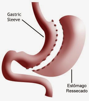 Gastrectomia Vertical