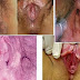 Obat Luka Sipilis Di Lubang Vagina thumbnail