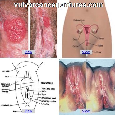 Picture of white lesions vulva cancer