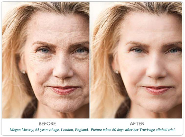 Differin Wrinkles Before After