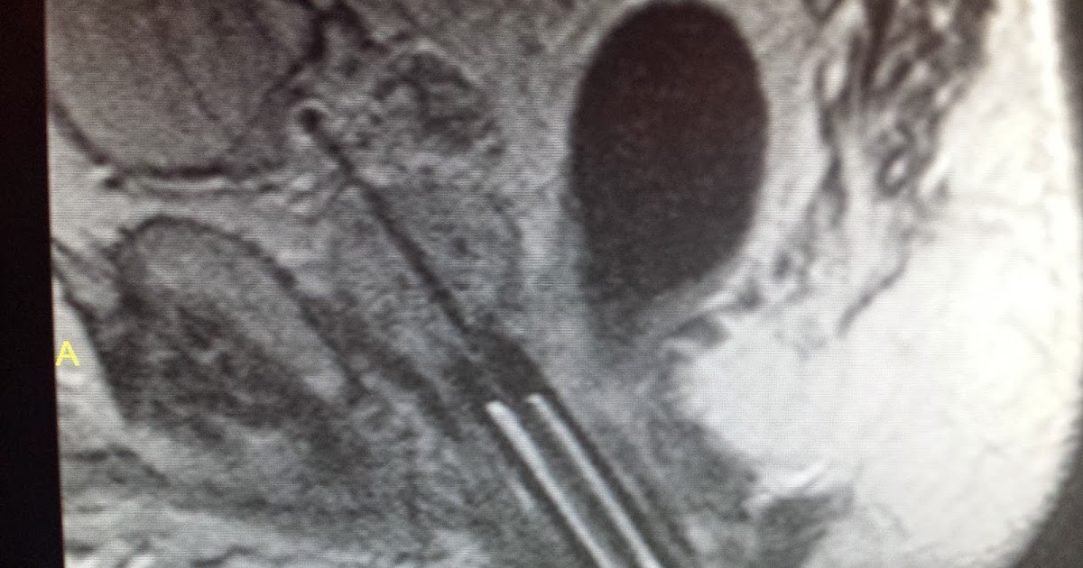 Perspectives UCLA Completes Safety Trial for MR guided