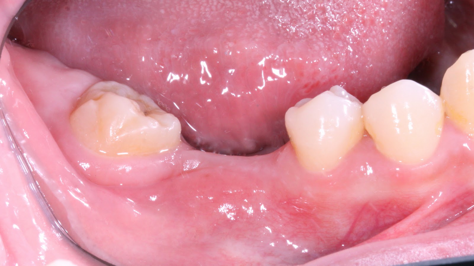 Immediate dental implant 測試 Q&A Dental Clinic