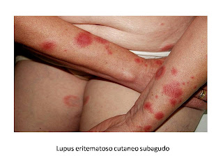 Lupus cutaneo subagudo