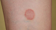 picture of Lichen Planus