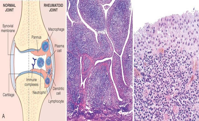 pathology of rheumatoid arthritis Genetic architecture, cellular pathology and even therapeutic for classification purposes, seronegative rheumatoid arthritis (ra) has become something of a. pathology of rheumatoid arthritis Genetic architecture, cellular pathology and even therapeutic for classification purposes, seronegative rheumatoid arthritis (ra) has become something of a.