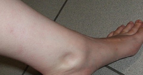 Si se hinchan los pies y se hinchan las venas detrás de la rodilla