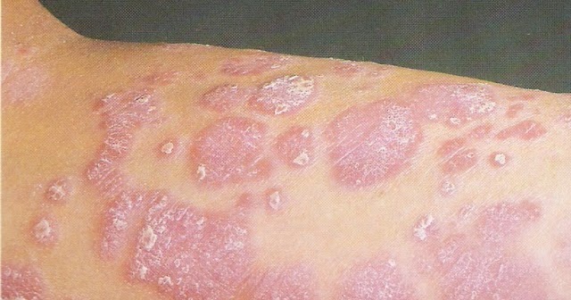 Que comer es nocivo a la psoriasis