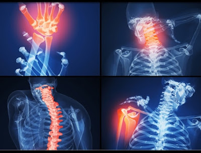 as patologias e a artrite reumatóide a artrite reumatóide é uma classe de patologias que ocasionam desconforto