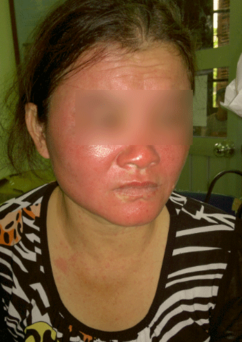 Một phụ nữ bị dị ứng nổi mẩn đỏ khắp mặt sau khi bôi kem mủ trôm.