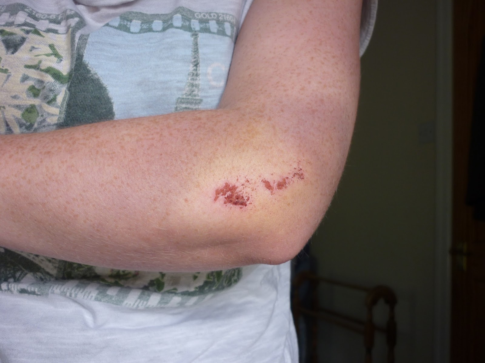 The art of living with Epilepsy.: August 2013