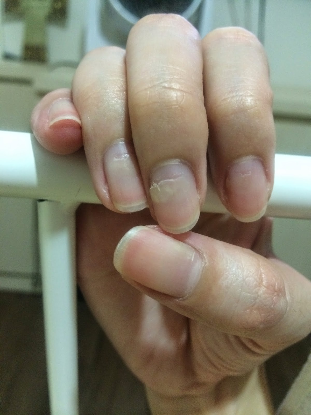 The Dettol Diaries Peeling Fingernails after HFMD