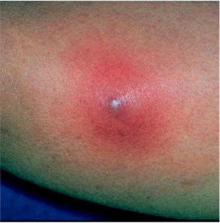 Cara Mudah Dan Alami Mengobati Bisul | Kecantikan Kesehatan dan Kehamilan