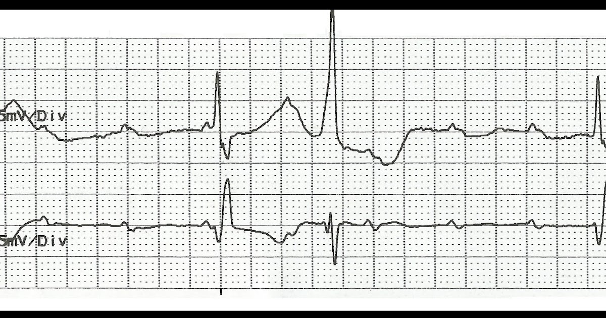 Float Nurse Practice EKG Rhythm Strips 156