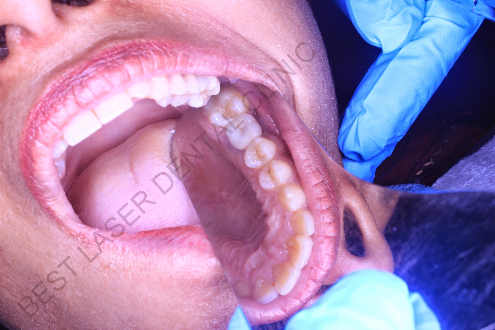 Zirconium crown cost in india Upper molar replacement with implant and