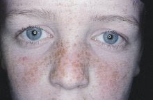 Leliminazione laser di pigmentary individua Mytishchi