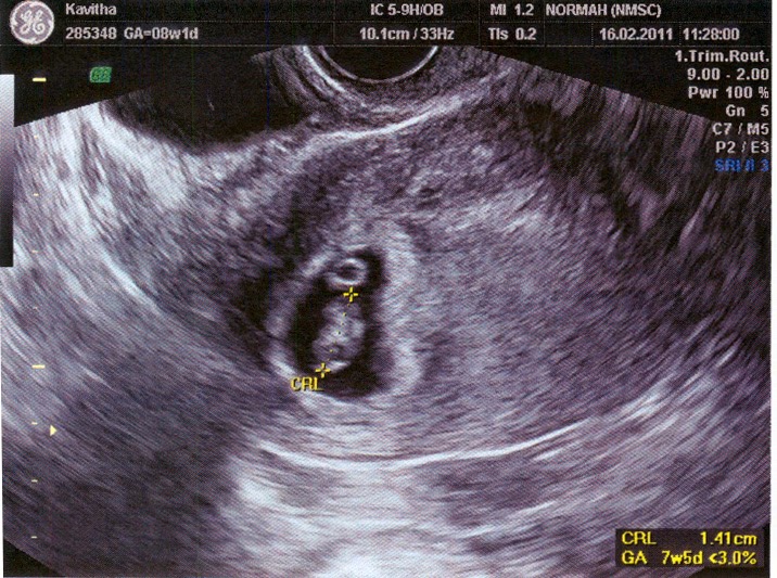 Ruthies�s Journal 8 Weeks Ultrasound Scan Photos