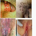 Obat Perontok Kutil Kelamin Pria thumbnail
