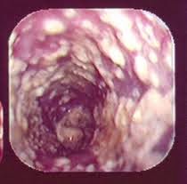 pomadas para curar candidiasis masculina
