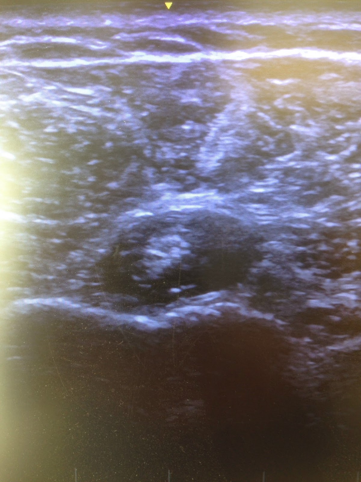 What Is A Bicipital Groove Injection at Lorraine Creason blog