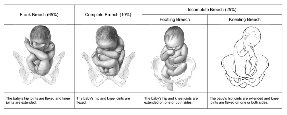 Types of breech presentation pdf image