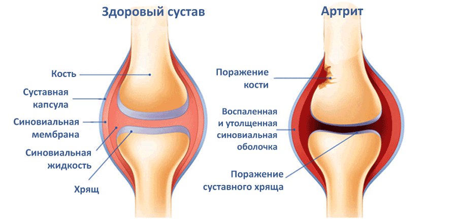 Дисплазия тазобедренных суставов и ходьба Дисплазия тазобедренных суставов и ходьба