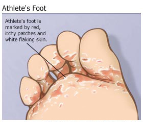 What are some common cures for athlete's foot?