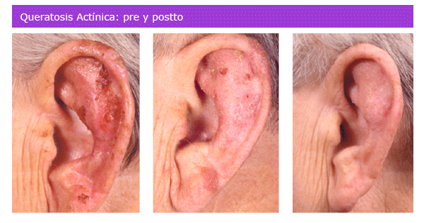 Terapia fotodinamica em dermatologia 67 Terapia fotodinamica em dermatologia 57