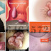 Obat Wasir (Hemoroid) Murah di Apotik 24 Jam thumbnail