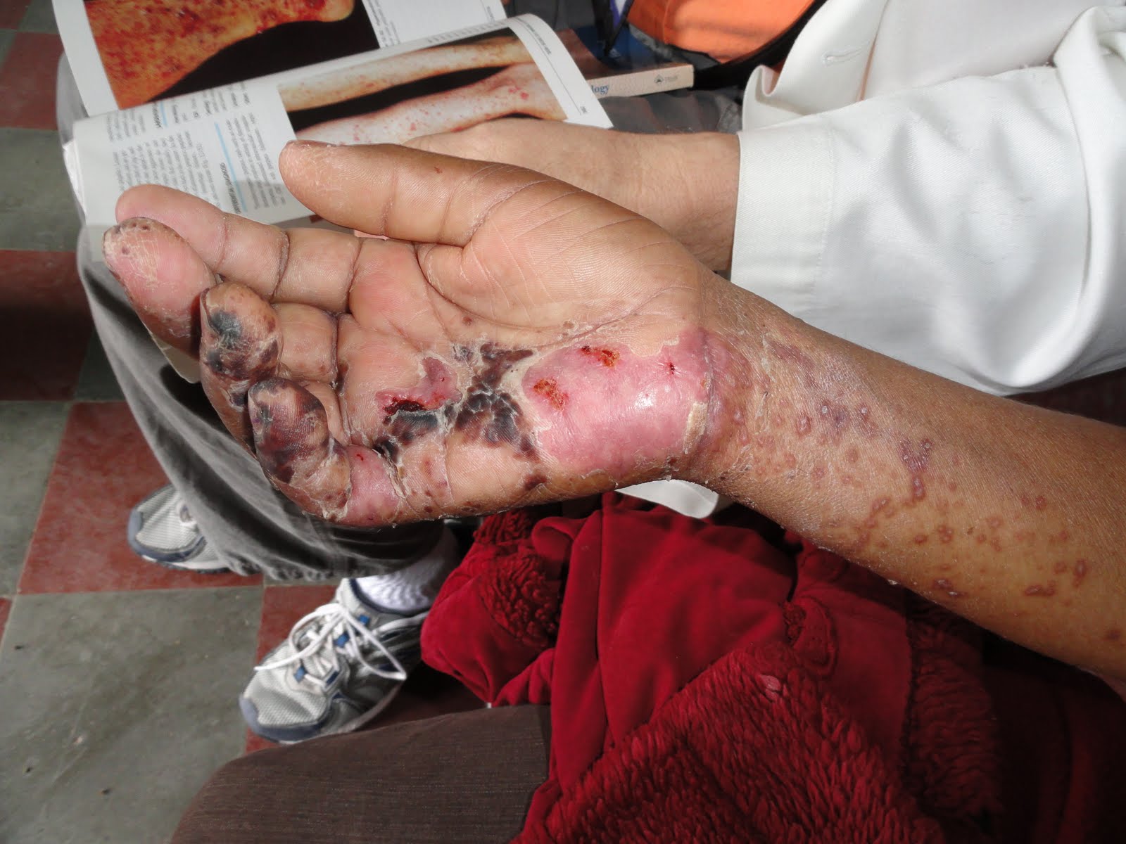 Hand Lesions