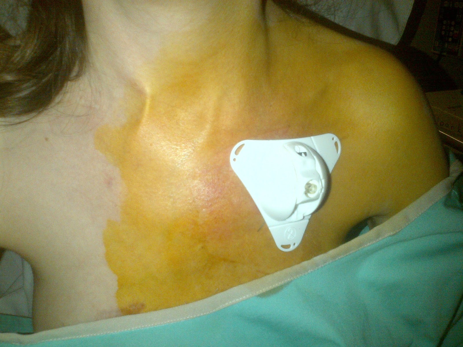 Deer Diary Punctured Lungs