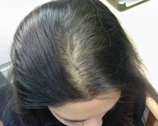 androgenetic alopecia care for your hair androgenetic alopecia