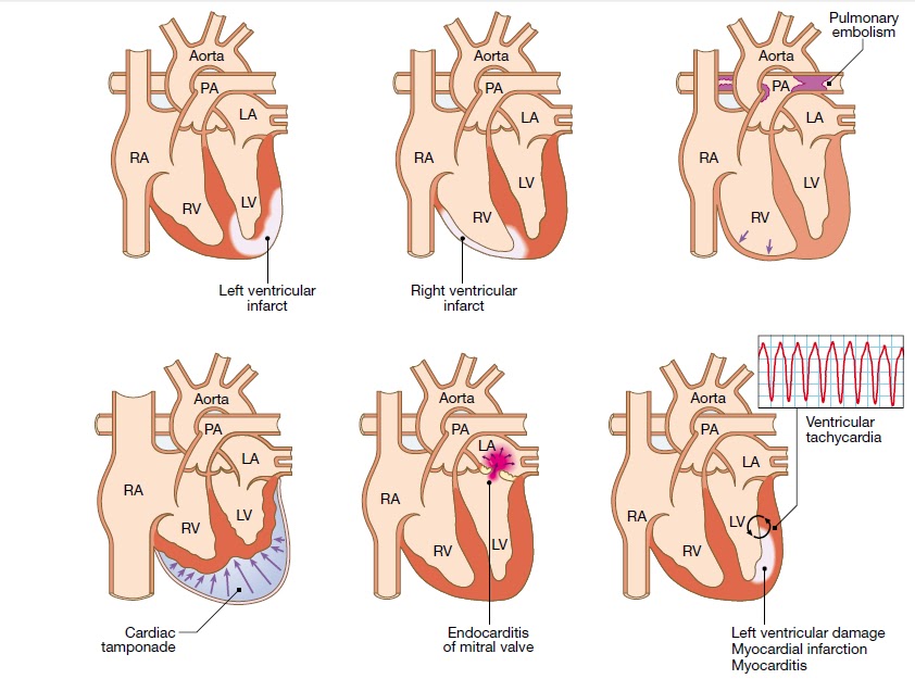 cardiogenic shock due to myocardial