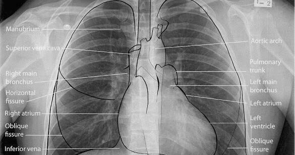 Medical Addicts: Chest X-Ray: Normal PA view