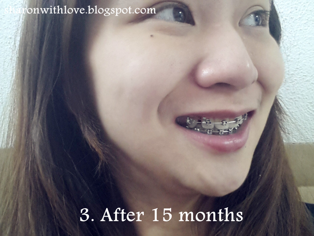 Live. Laugh. Love Before and After 15 Months of Putting On Braces